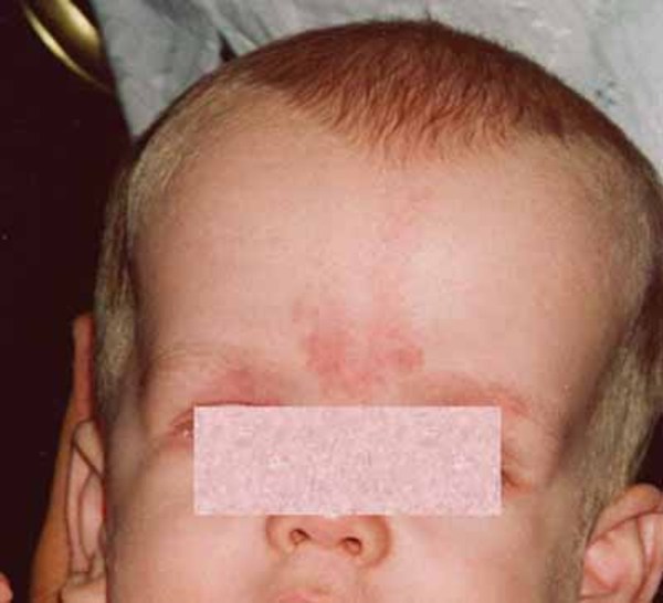 Prader-Willi syndrome: MedlinePlus Genetics