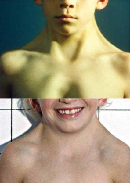 people born without a neck