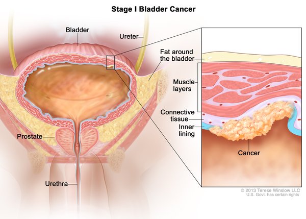 mesothelioma cancer of pleura