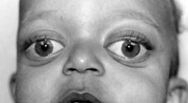 kaste støv i øjnene Konsulat indendørs Apert syndrome: MedlinePlus Genetics