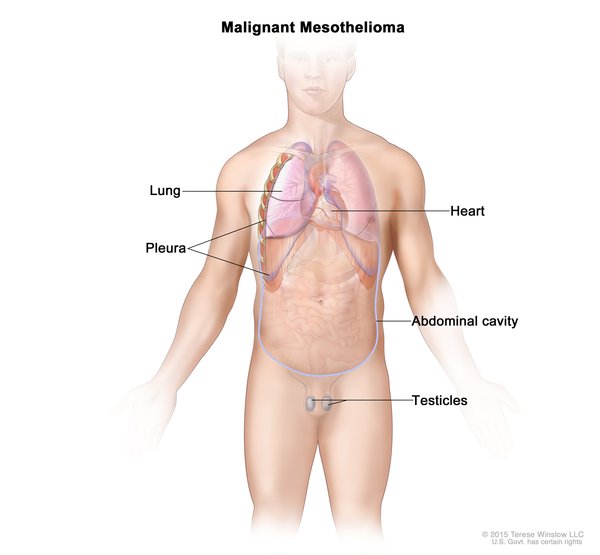 signs of early stage mesothelioma