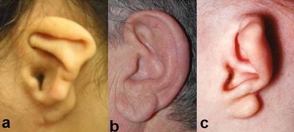 Ear Lobe Repair Before and After Pictures Case 174