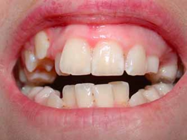 apert syndrome teeth