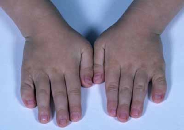 Clubbed fingers: MedlinePlus Medical Encyclopedia Image