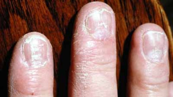 Hair loss and nail atrophy | Download Scientific Diagram