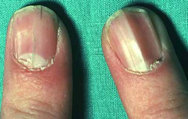 Nail Psoriasis | The Chelsea Clinic Chiropodists Podiatrists