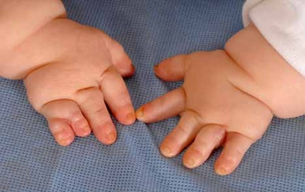 Curtis Wilson on X: @BabyHand2 Little Hand. Baby hands have inverted  chubby knuckles, whereas the aforementioned hand is matured.   / X