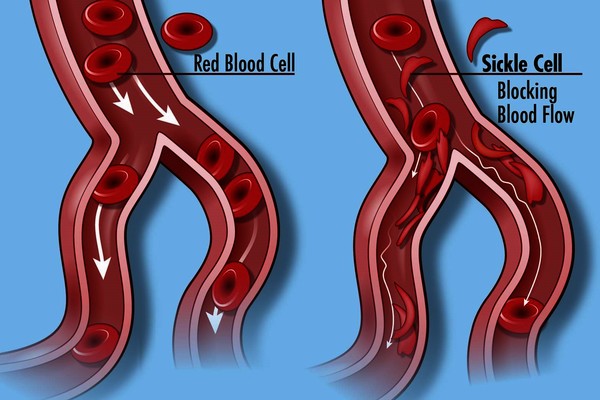 sickle cell anemia hemoglobin