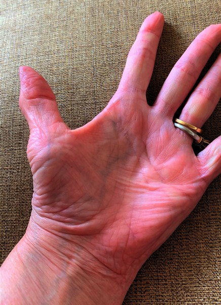 what is the proper medical term for your thumb?