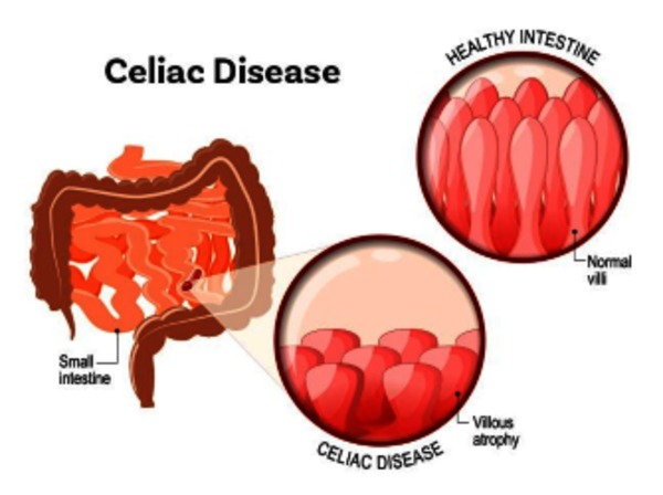 Celiac disease: MedlinePlus Genetics