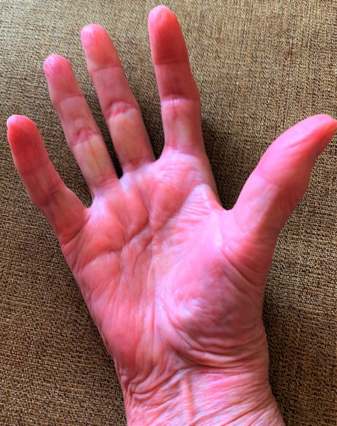 14 Pcs Finger Splints - Finger Splint Sizing Kit for Arthritis, Mallet  Finger - Thumb Splint, Trigger Finger Splint For Thumb, Middle, Pinky or Ring  Finger (A Complete Kit (Sizes 2~15)) - Walmart.com