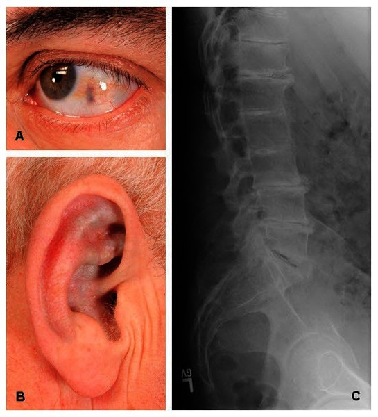Photo A shows ochronosis of they eye. Photo B shows ochronosis of the ear. Photo C shows an x-ray image of the lower spine with disc flattening, calcification, and osteophyte formation.