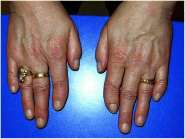 Clubbed fingers: MedlinePlus Medical Encyclopedia Image