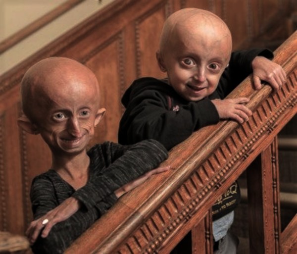 Progeria neonatal Progeria Syndrome