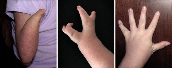 Small and short hands in girl with Cohen syndrome.