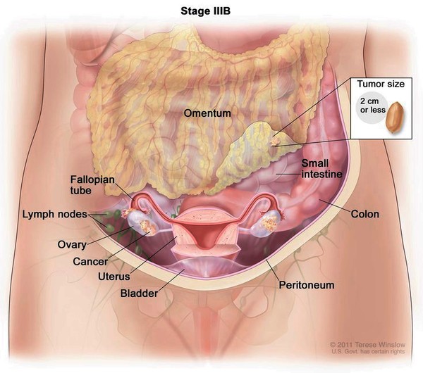 Alila Medical Media, Breast Cancer stages diagram.