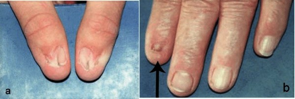 Nail-patella syndrome. A case with a de novo mutation in the LMX1B gene not  previously described | Nefrología