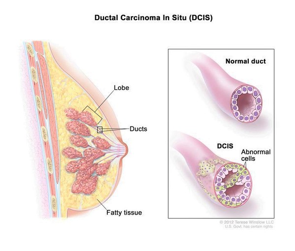 Ductal carcinoma in situ (DCIS); drawing shows a lobe, ducts, and fatty tissue in a cross section of the breast. The inset shows a normal duct and a duct with abnormal cells.