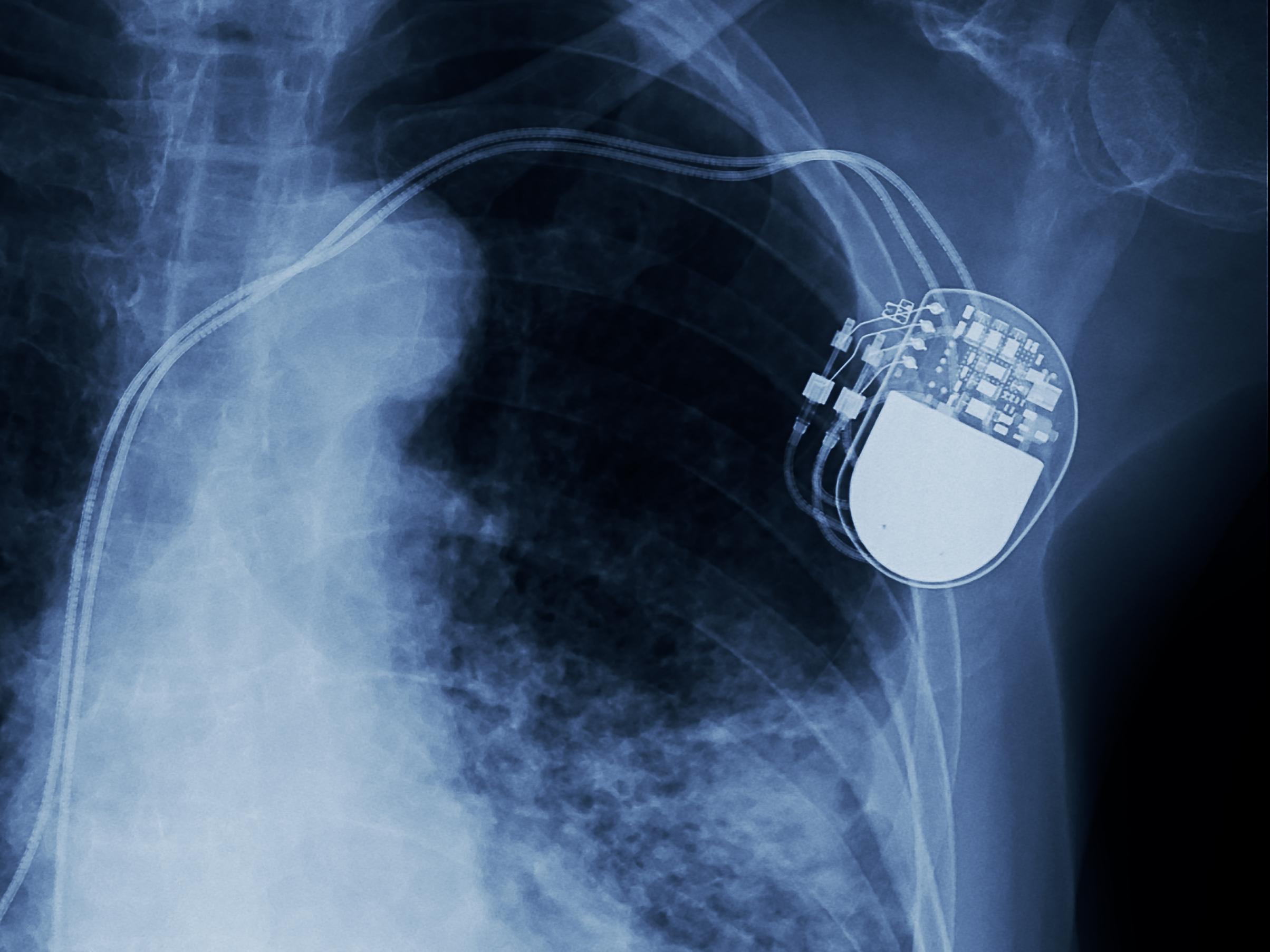 Update 161+ smart watch pacemaker - vietkidsiq.edu.vn