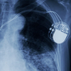 Pacemakers and Implantable Defibrillators