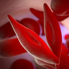 Sickle Cell Disease | Sickle Cell Anemia | MedlinePlus