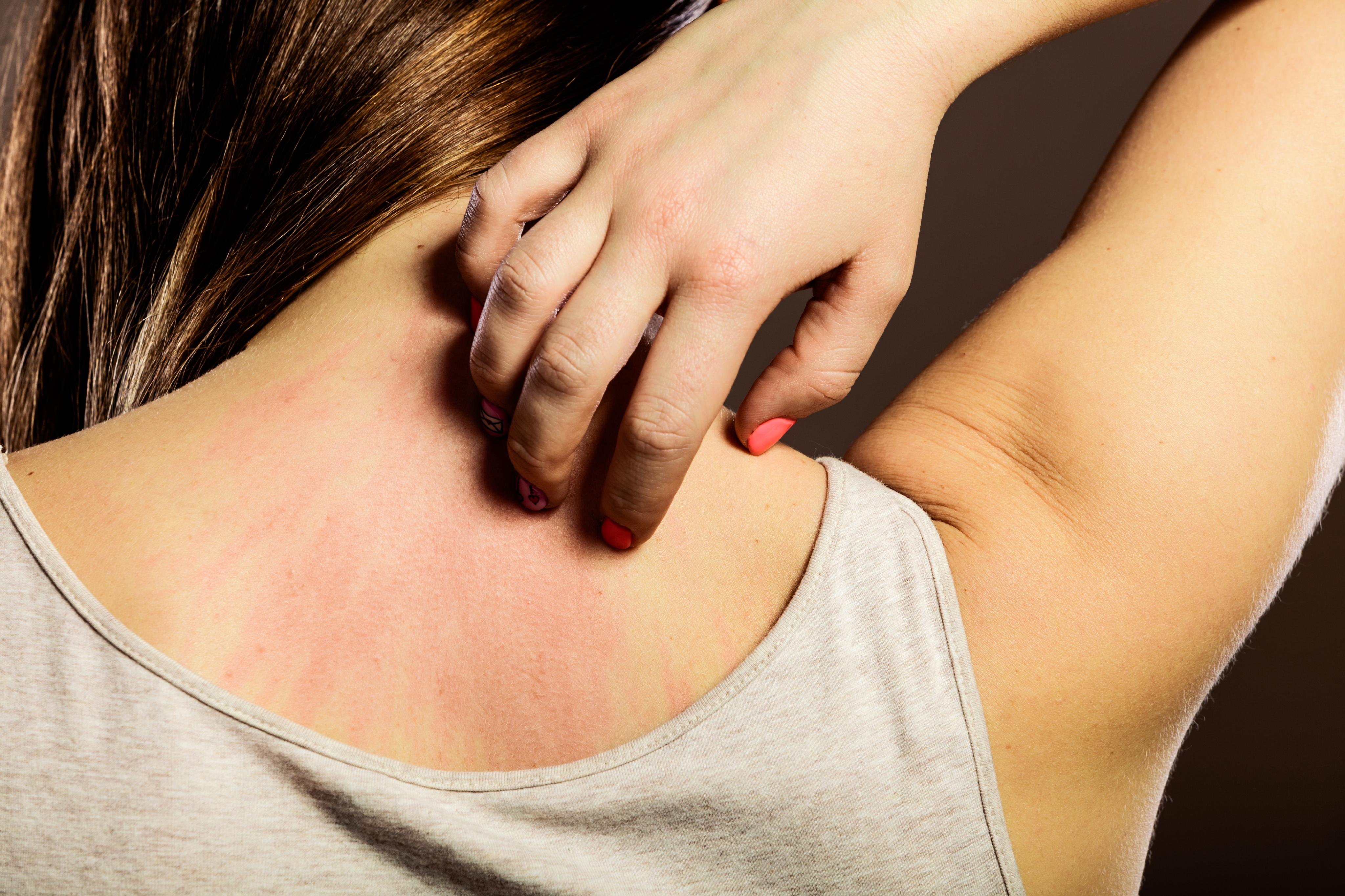 Skin Conditions | Hives | Acne | MedlinePlus
