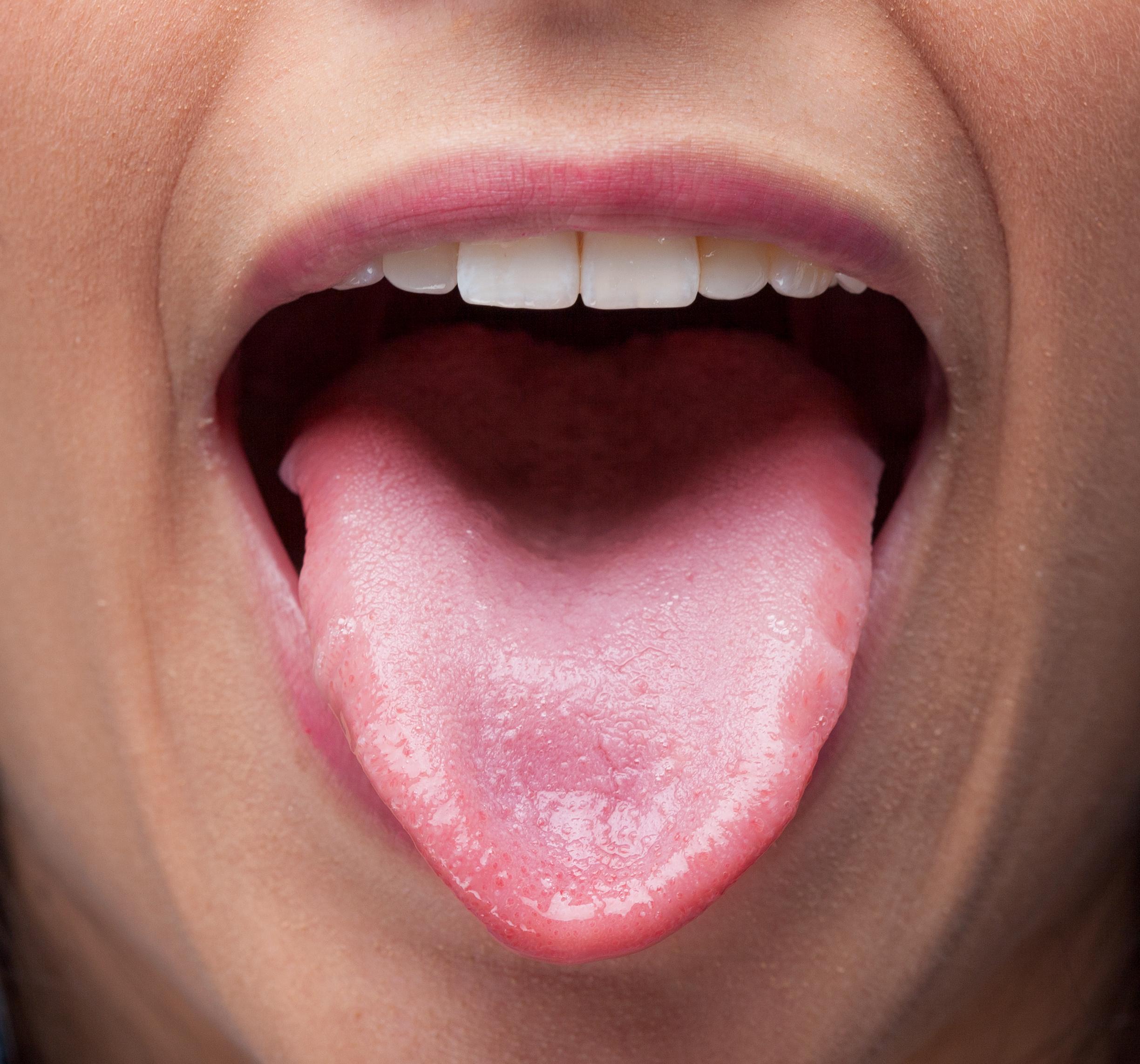 Tongue Disorders Medlineplus