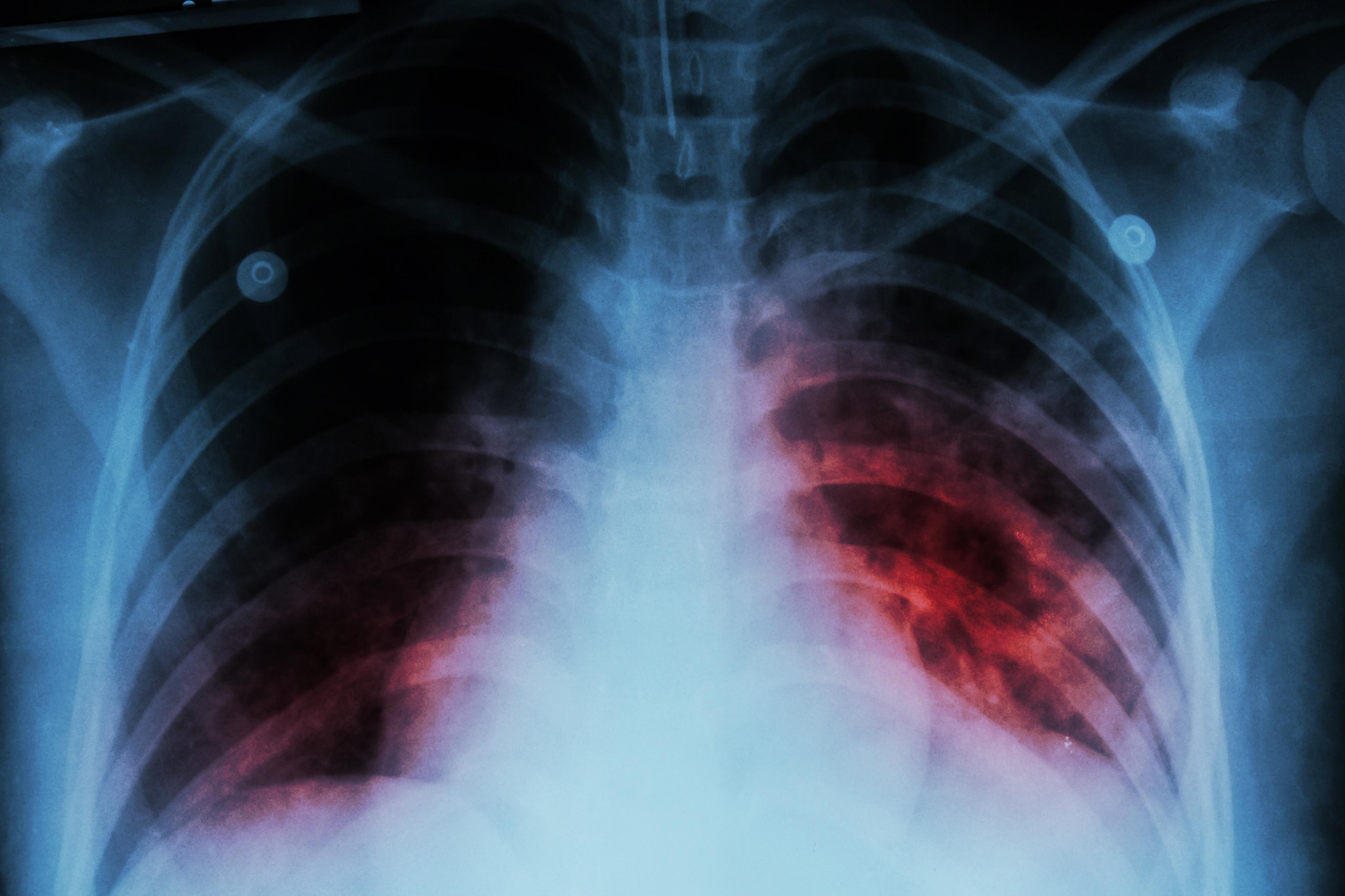 El rol de las enfermeras en el cuidado de pacientes con Tuberculosis