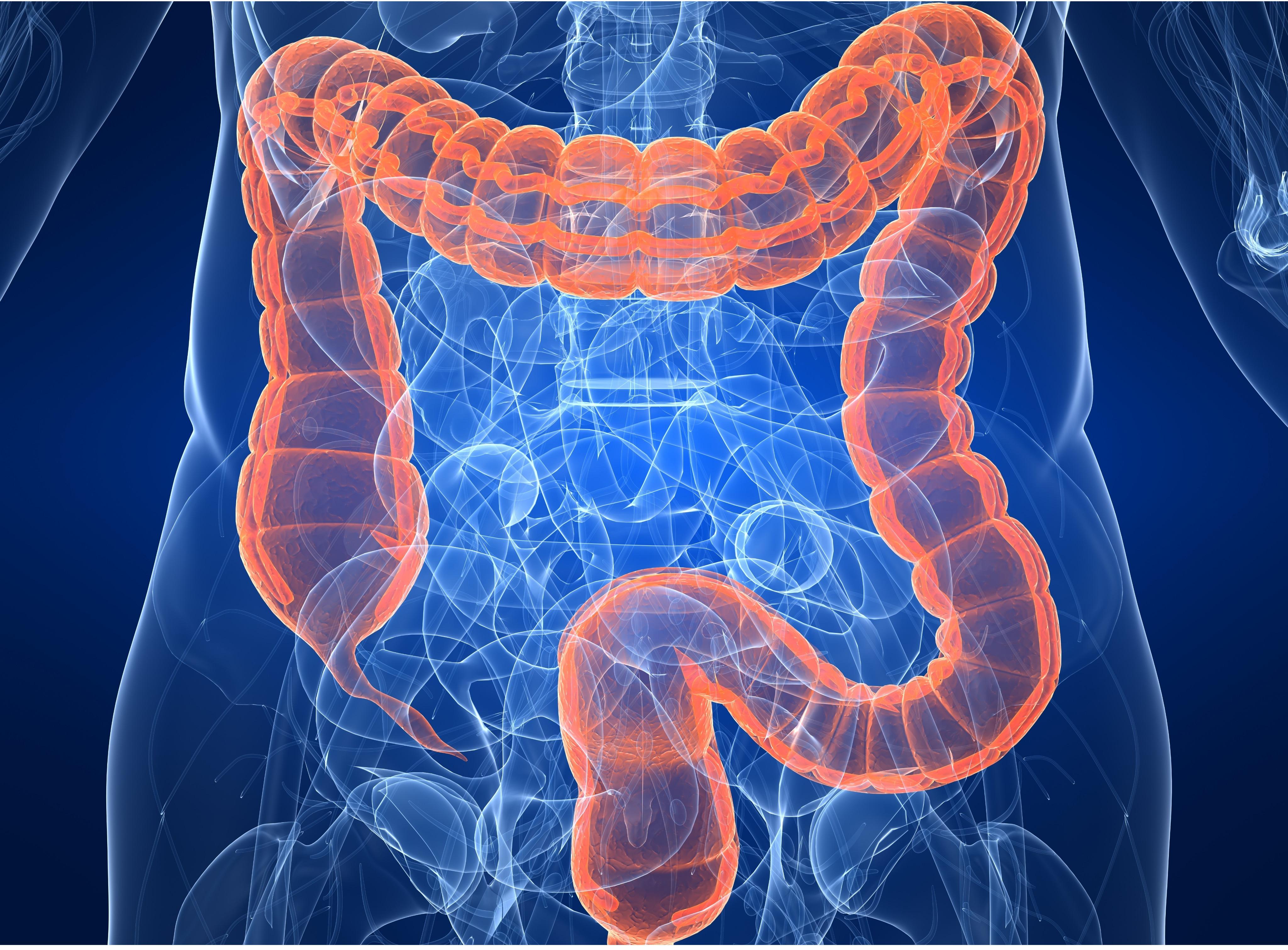 Colorectal Cancer Colon Cancer Rectal Cancer MedlinePlus