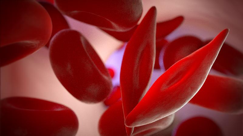 Sickle Cell Disease