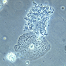 Micrografía de vaginosis bacterial