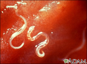 Anquilostoma - Ancylostoma caninum
