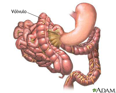 V lvulo MedlinePlus Enciclopedia M dica Illustraci n