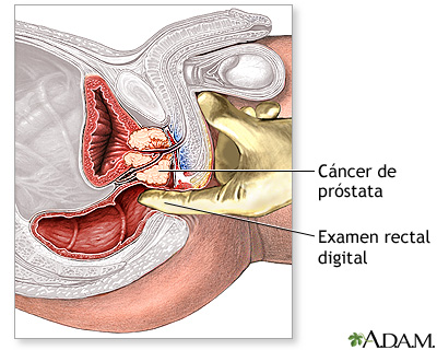 Cancer de prostata jovenes, Clinica Academica (academicamedica) on Pinterest