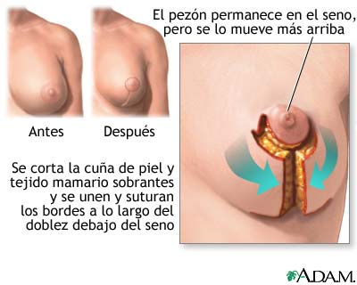 Mamoplastia