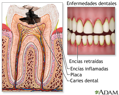 Caries dentales: MedlinePlus enciclopedia
