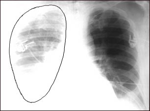 Ruptura aórtica - radiografía de tórax