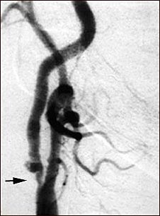Estenosis carotídea - radiografía de la arteria derecha