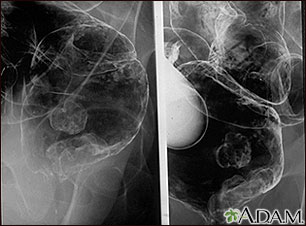 Rayos X - de un cáncer rectal