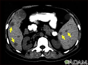 Metástasis en el bazo y el hígado – escaneo por TC