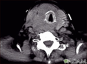 Tomografía computarizada de cáncer de tiroides
