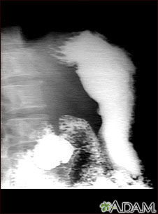 Radiografía de úlcera estomacal