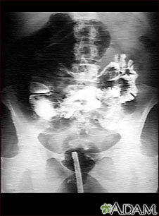 Radiografía de vólvulo