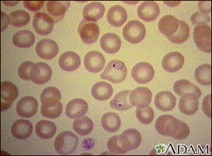 Malaria - vista microscópica de parásitos celulares
