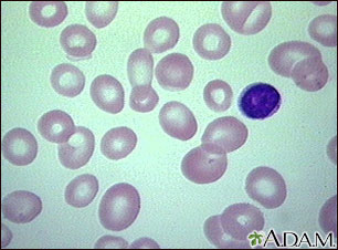 Anemia megaloblástica - Vista de los glóbulos rojos sanguíneos