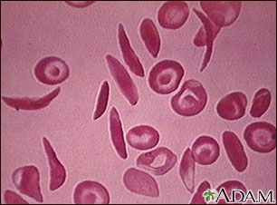 Glóbulos rojos - drepanocíticos múltiples