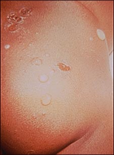 Mentor carbón Mamá Impétigo - ampollas en las nalgas: MedlinePlus enciclopedia médica  illustración