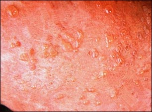 Acercamiento de lesiones por dermatitis herpetiforme
