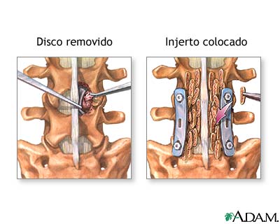 Injerto de hueso de la columna vertebral (segunda parte): enciclopedia médica