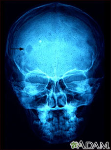 Granuloma eosinofílico - Radiografía del cráneo